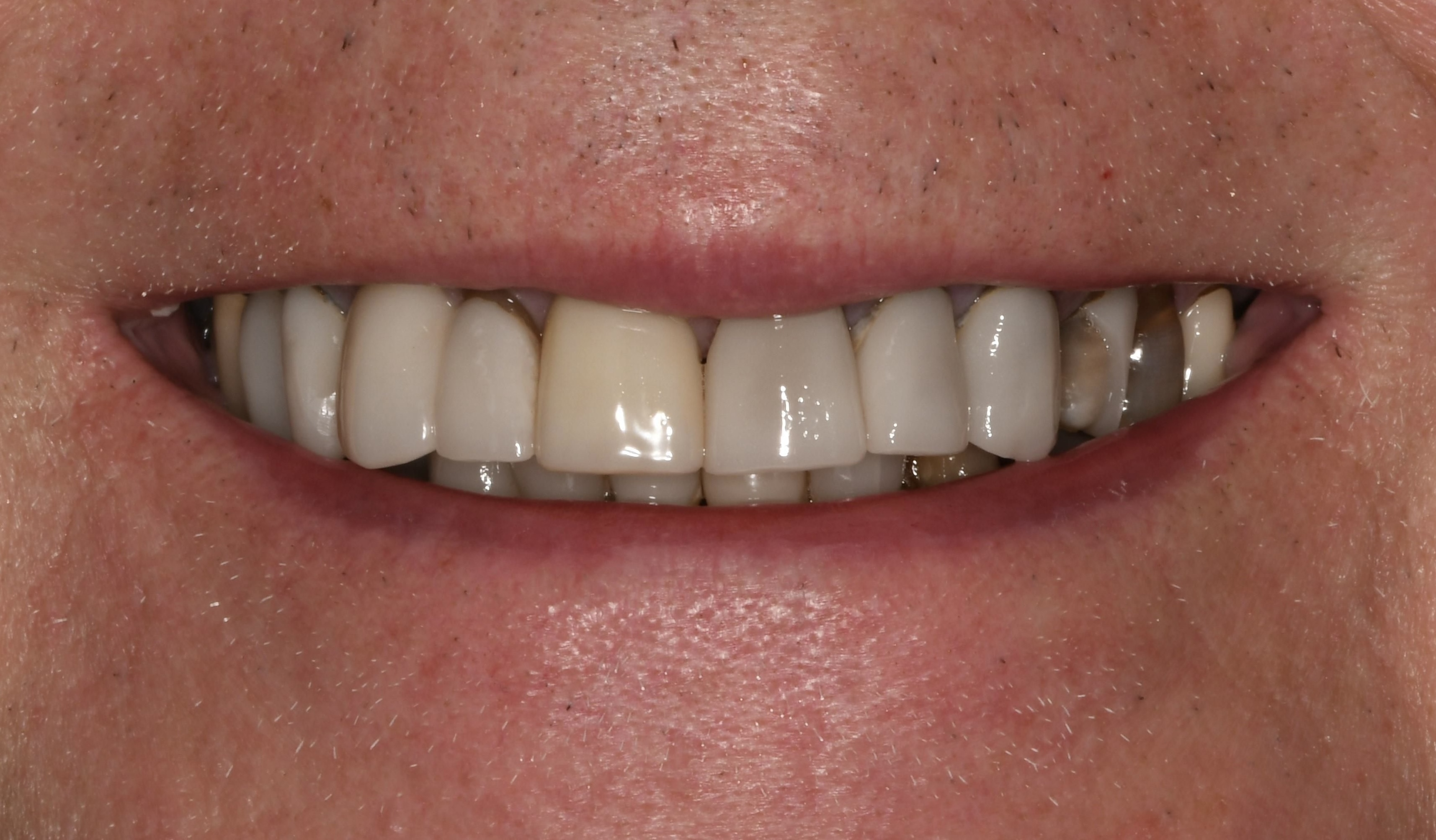 After teeth whitening