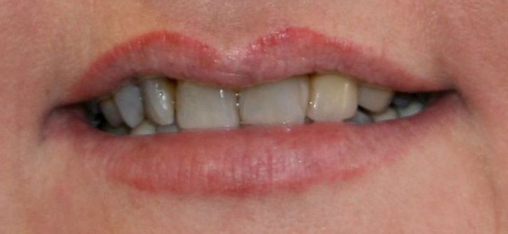 After dental implants