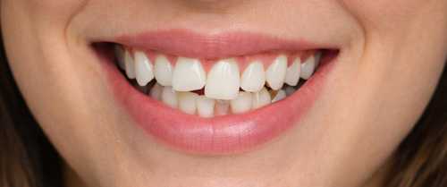 After smile makeover