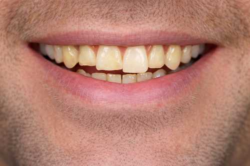 After smile makeover