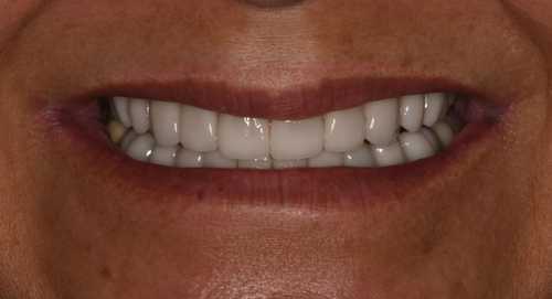 Before smile makeover