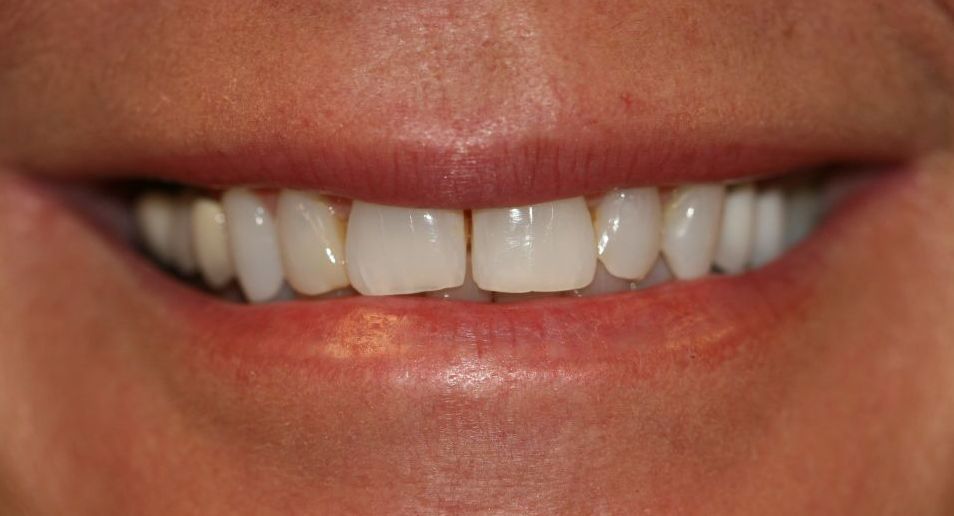 After dental veneers