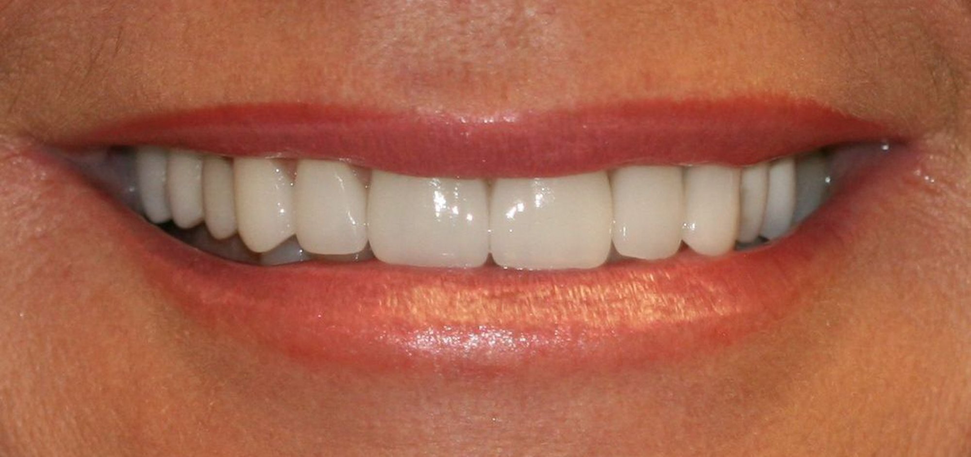 Before dental veneers