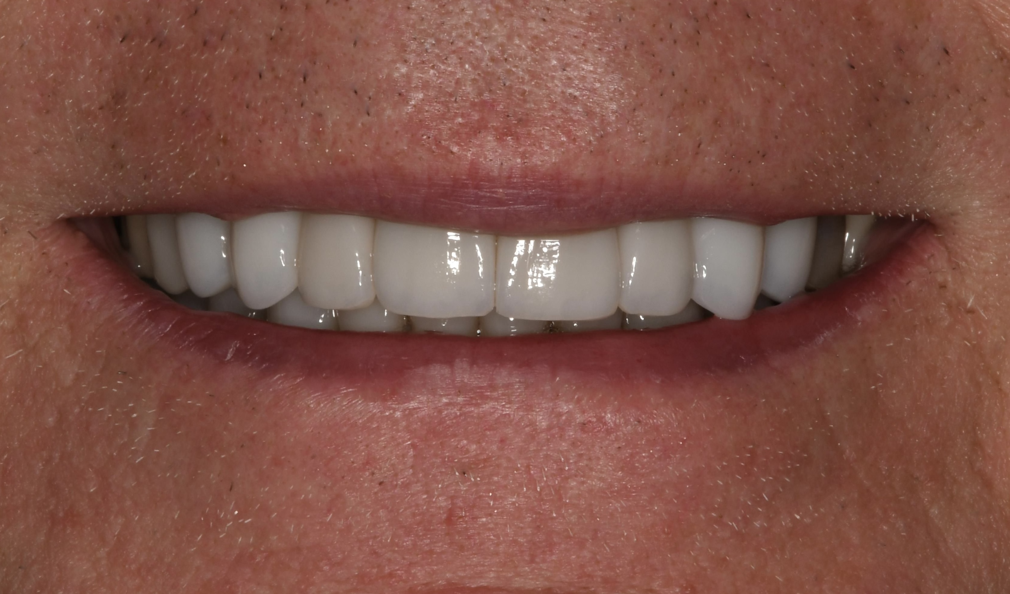 Before teeth whitening