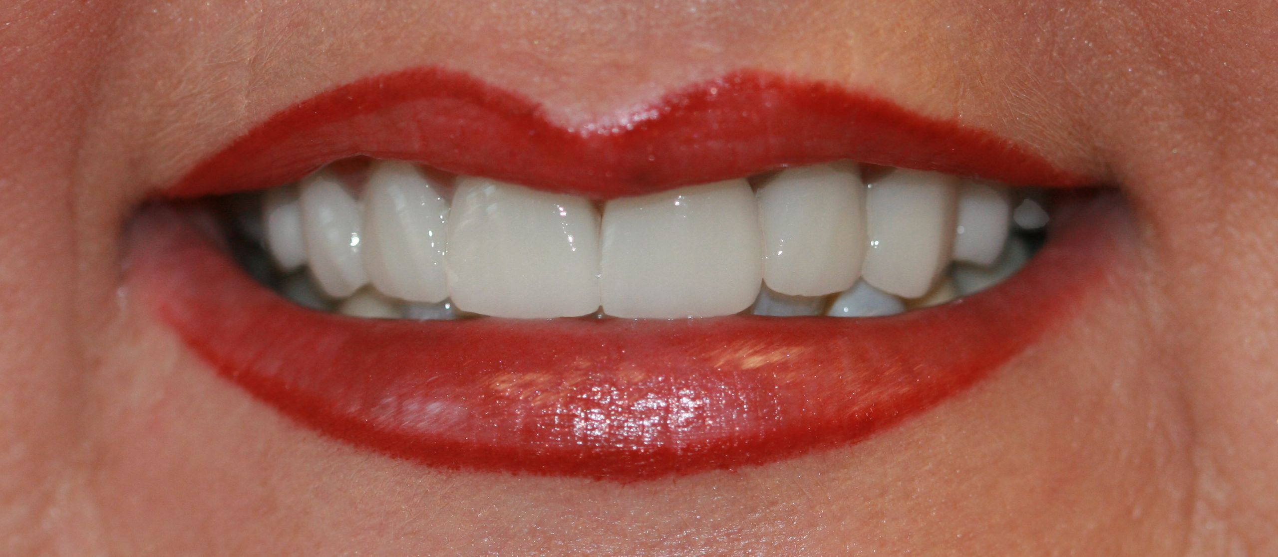 Before dental implants